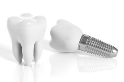 dental implants
