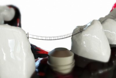 dental implant model